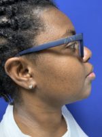 Neck liposuction- Lipectomy