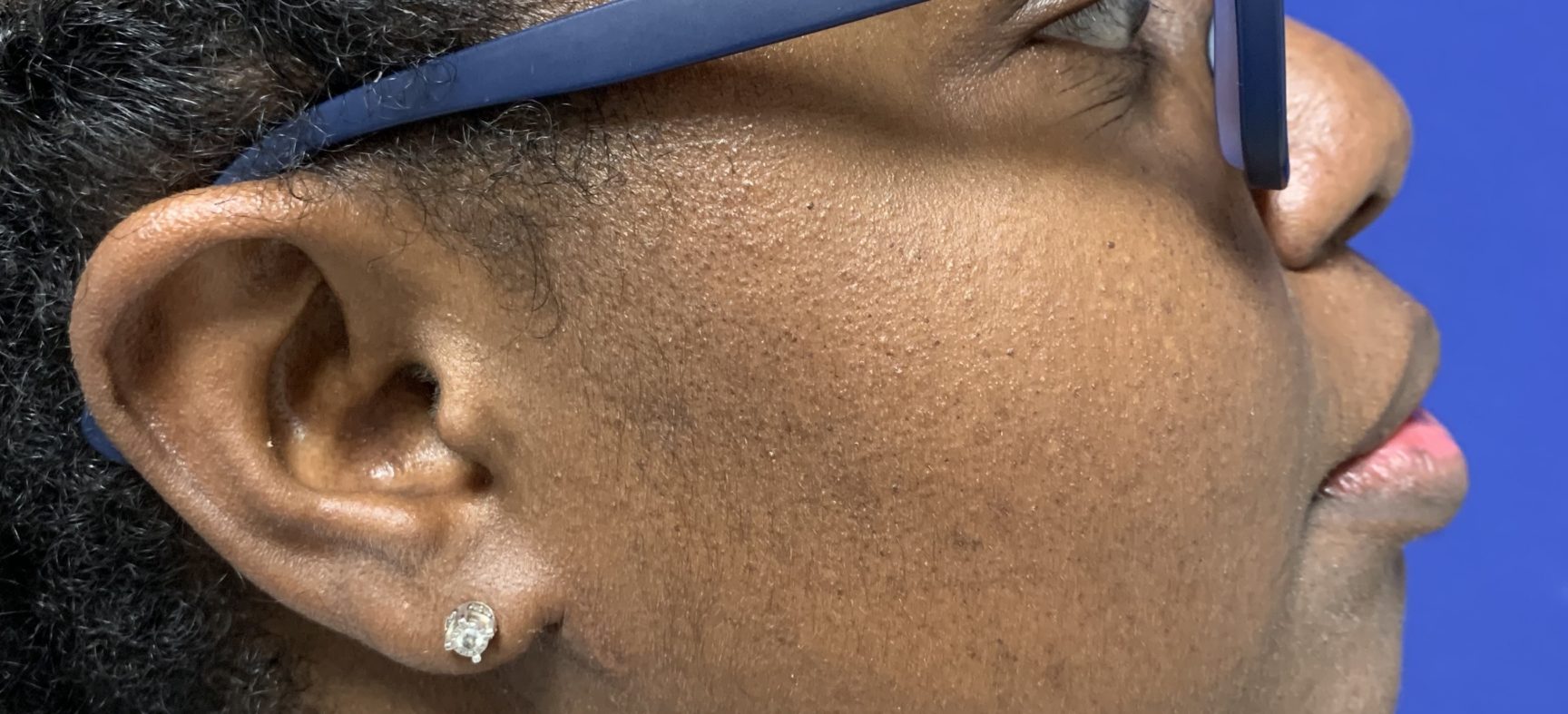Neck liposuction- Lipectomy