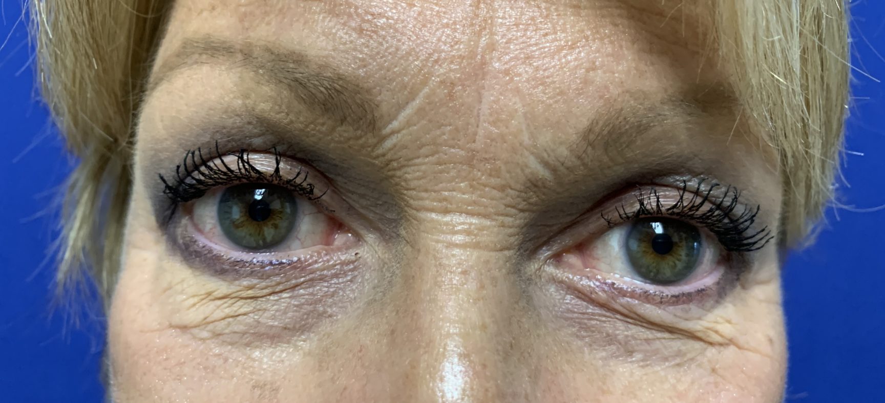 Eyelid surgery- Blepharoplasty