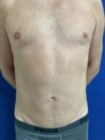 Liposuction