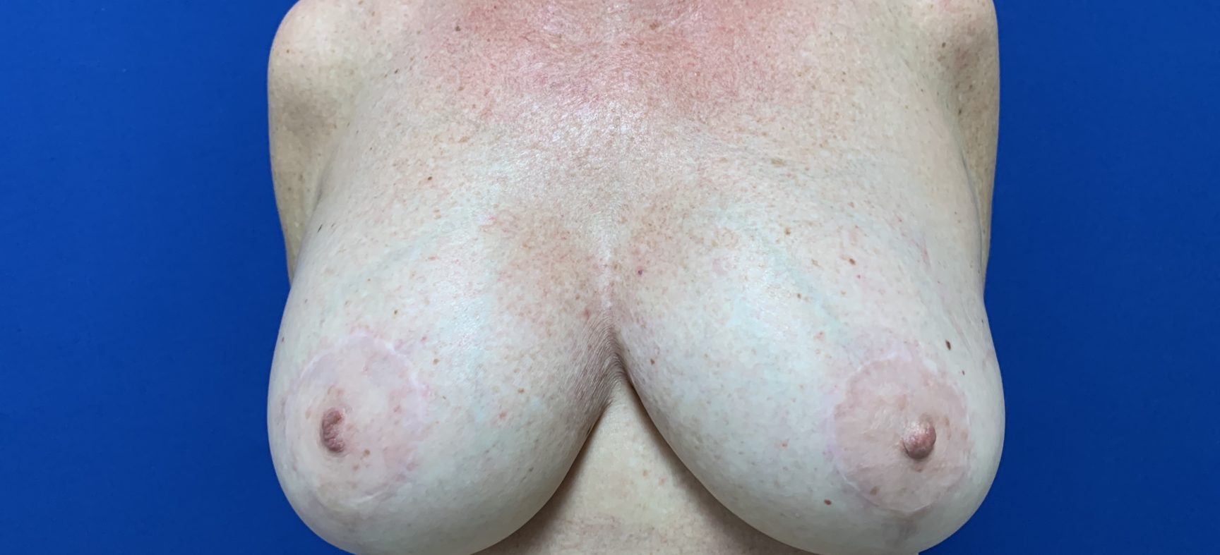 Breast lift