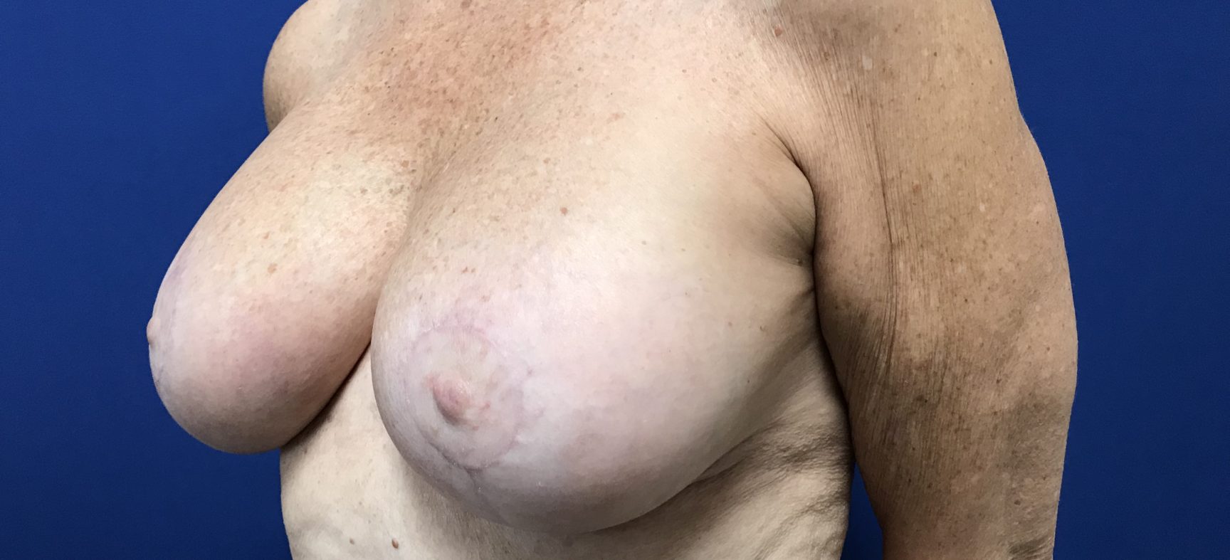 Breast Lift
