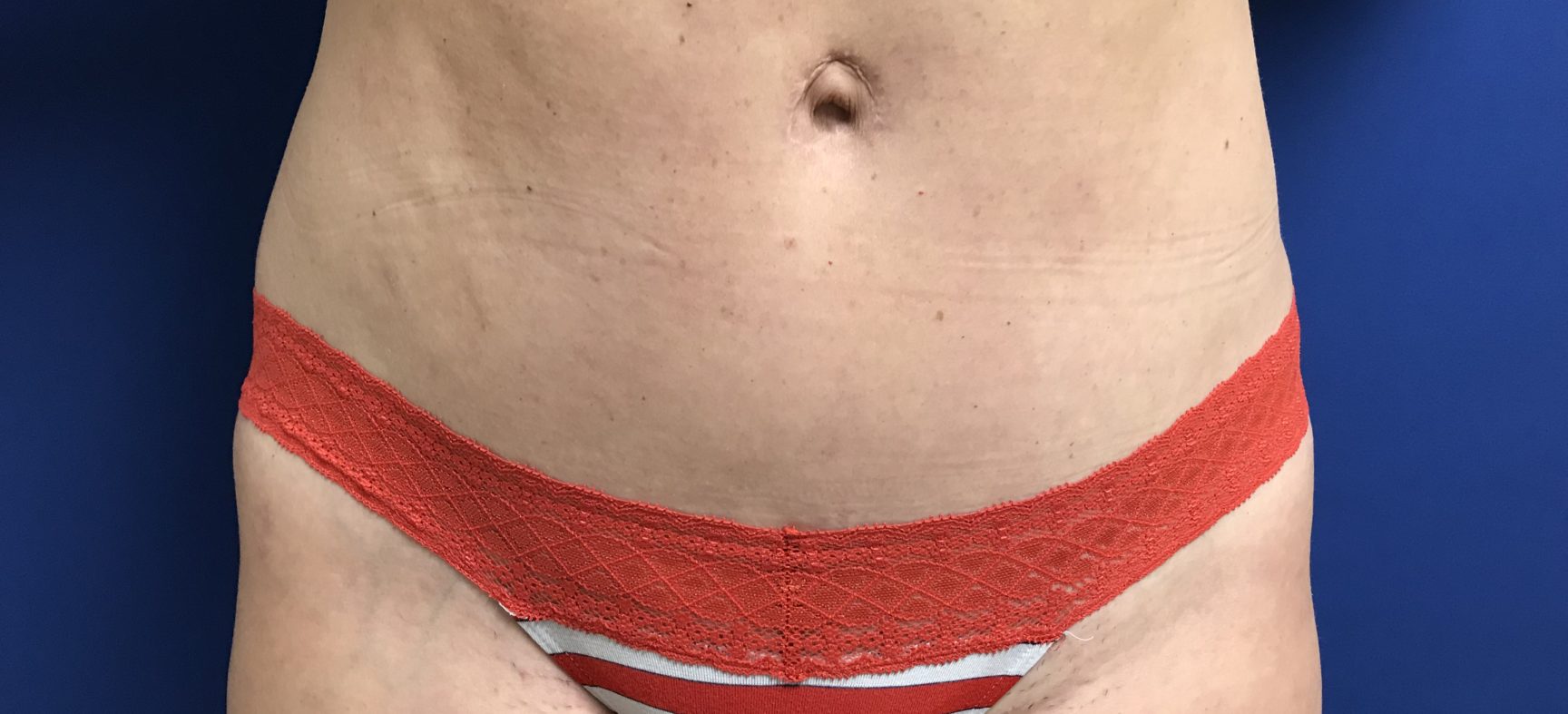 Tummy Tuck-Abdominoplasty