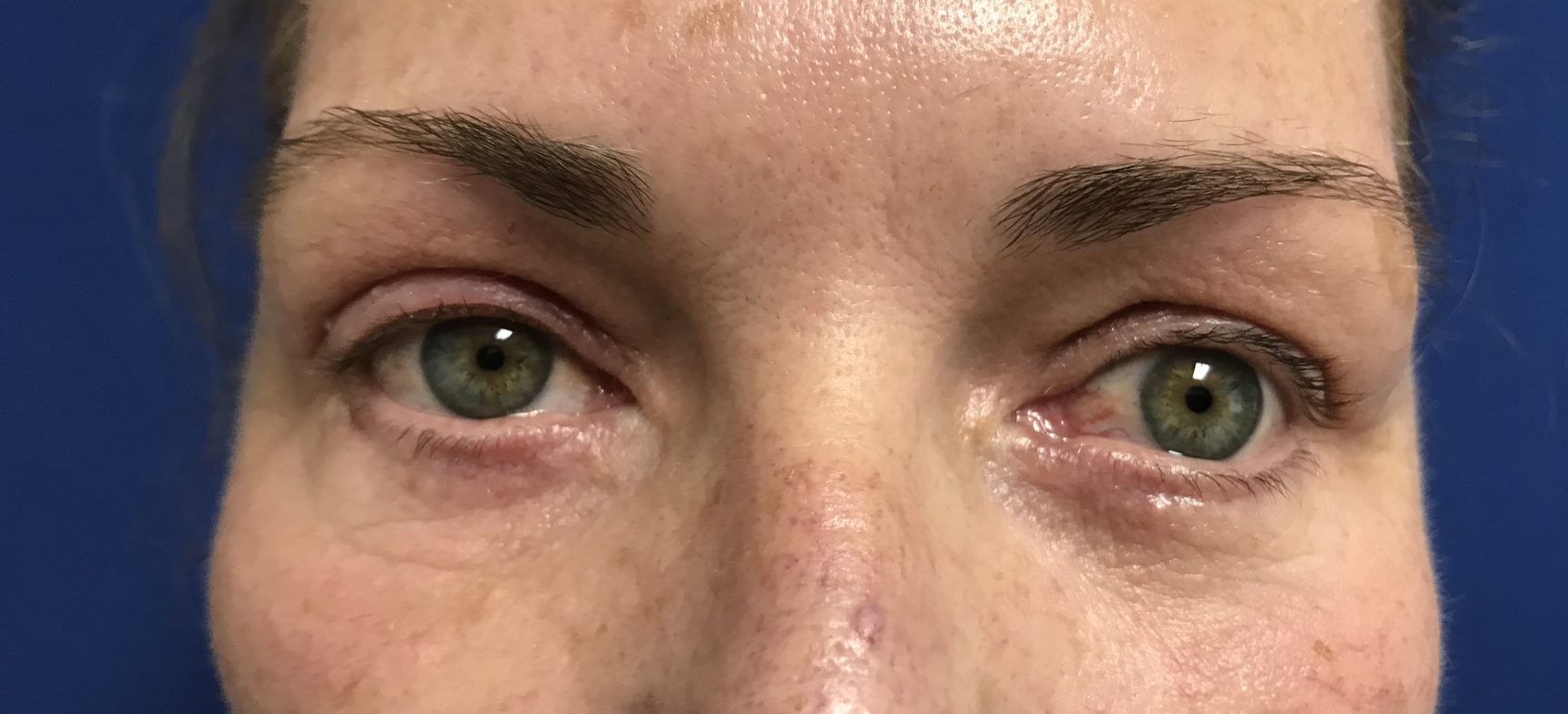 Facial fat grafts