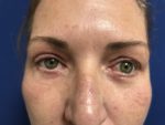 Eyelid surgery-blepharoplasty