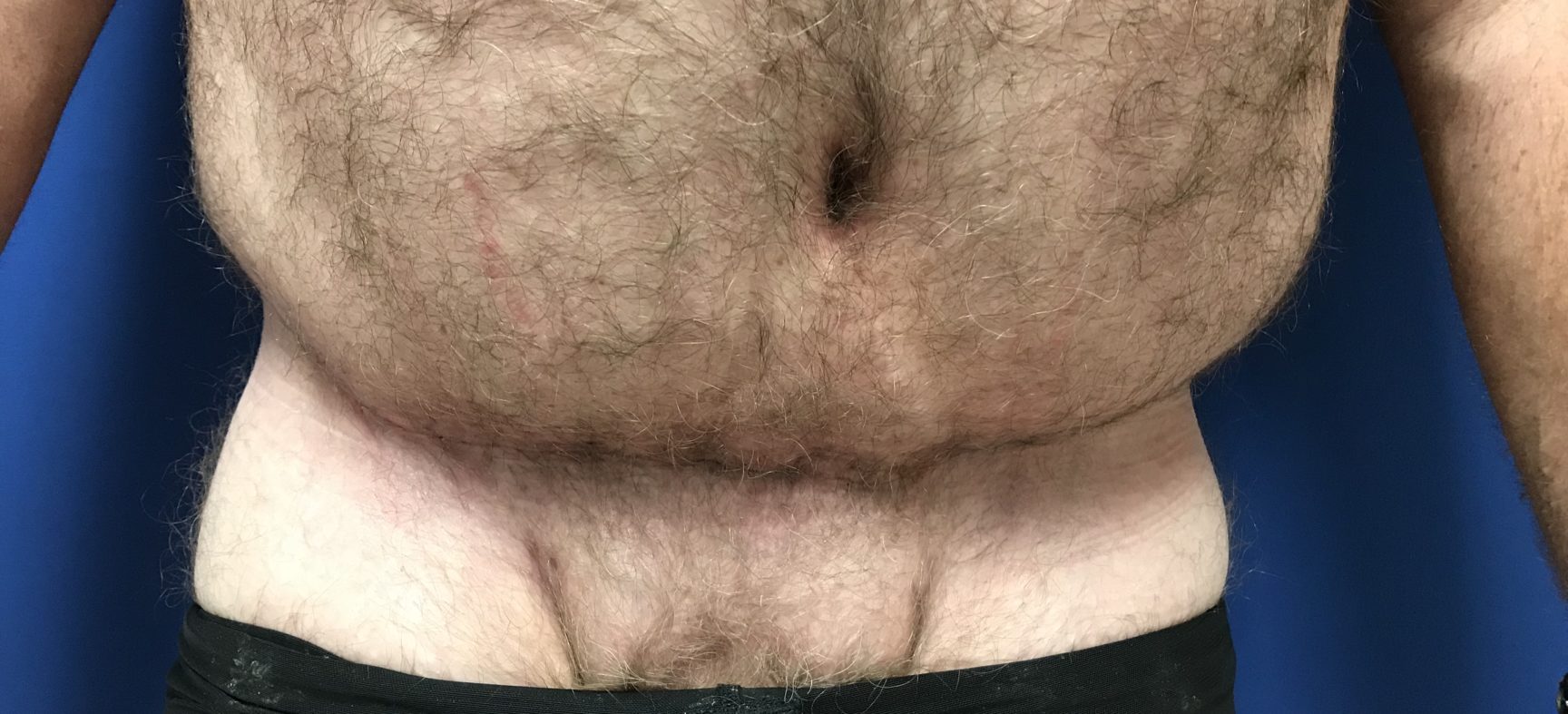 Tummy Tuck-Abdominoplasty