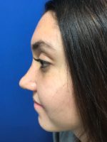 Rhinoplasty
