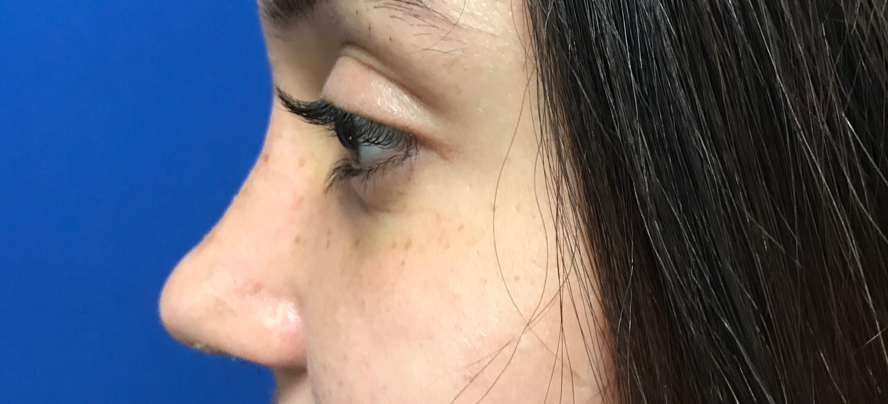 Rhinoplasty