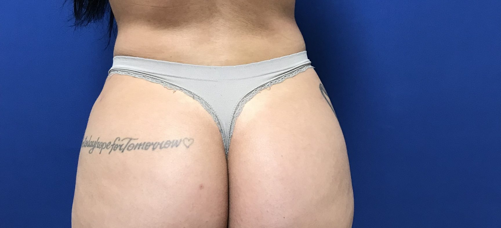 Liposuction