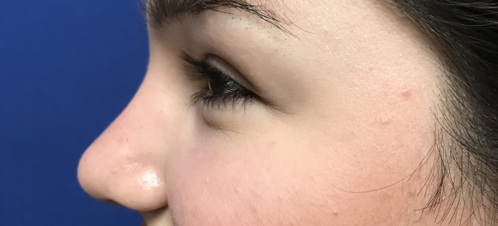 Rhinoplasty