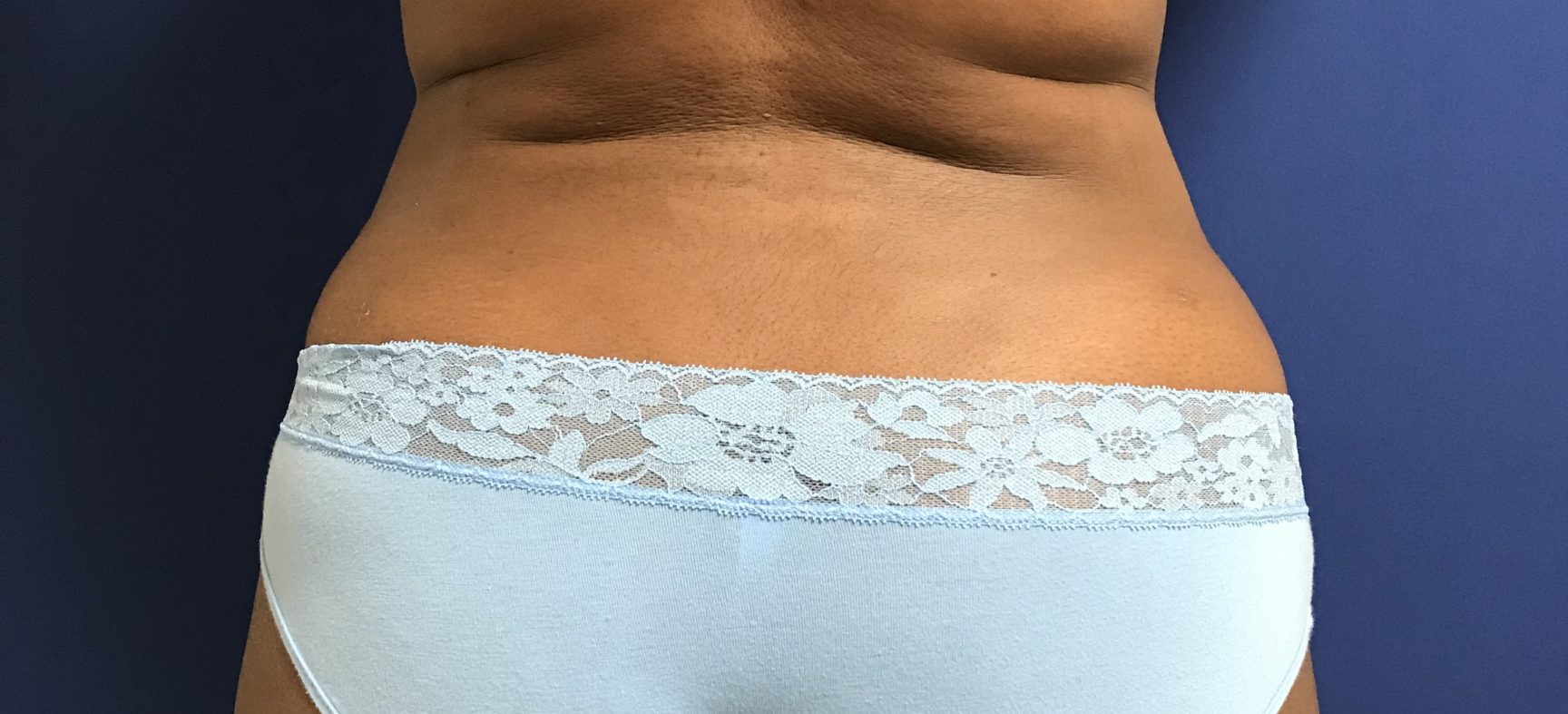 BBL-Brazilian Butt Lift