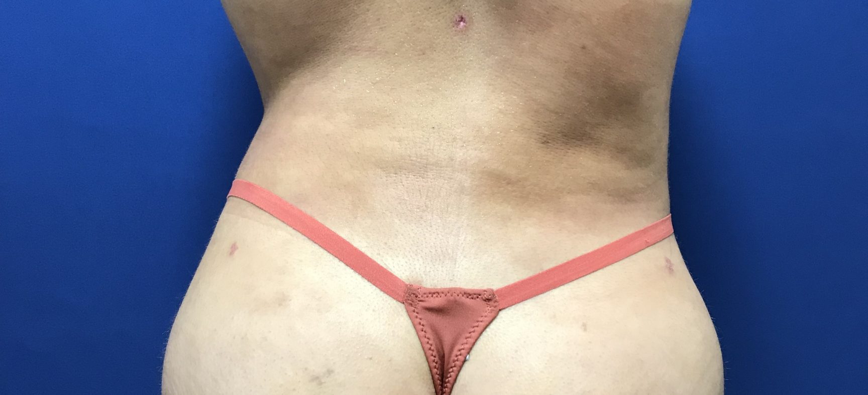 BBL-Brazilian Butt Lift