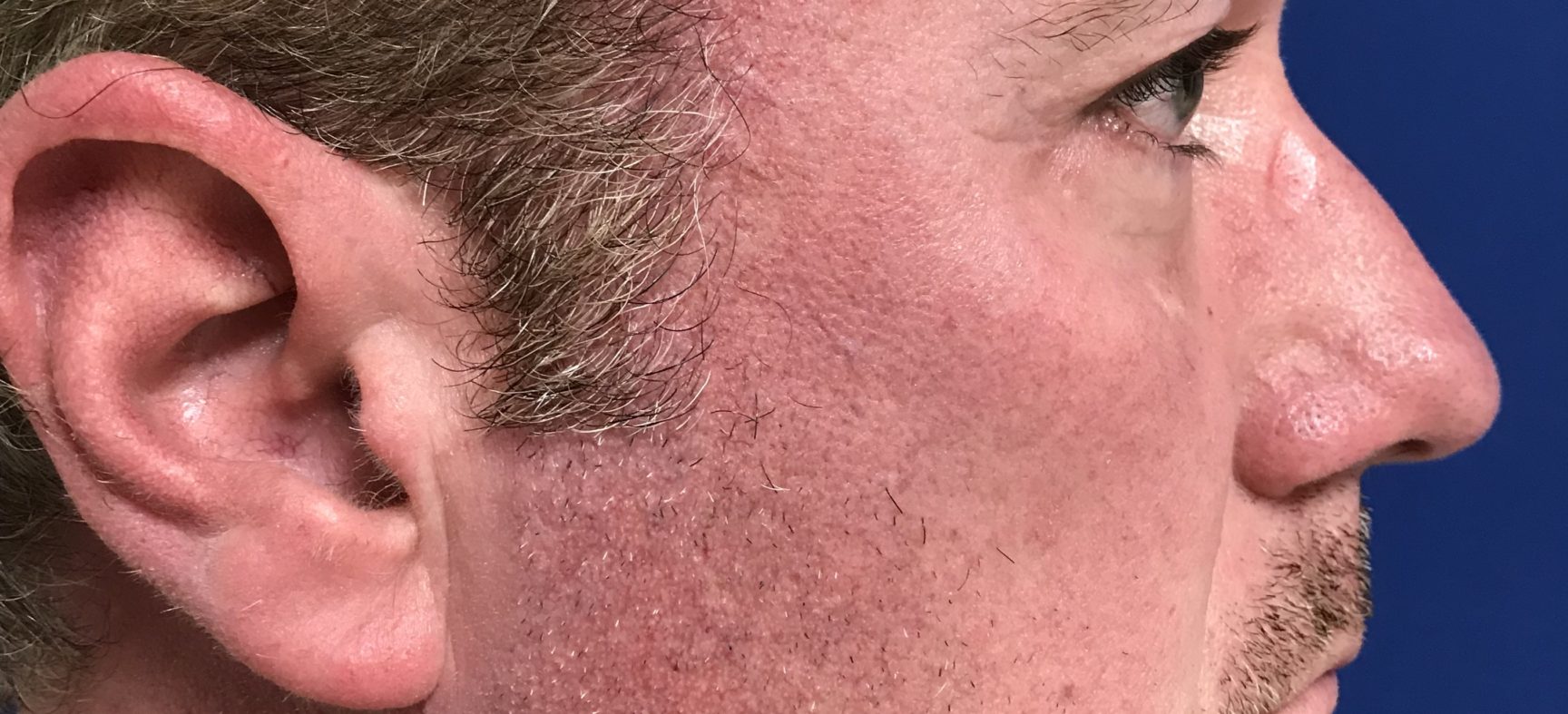 Facial fat grafts