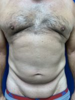 Tummy tuck-Abdominoplasty