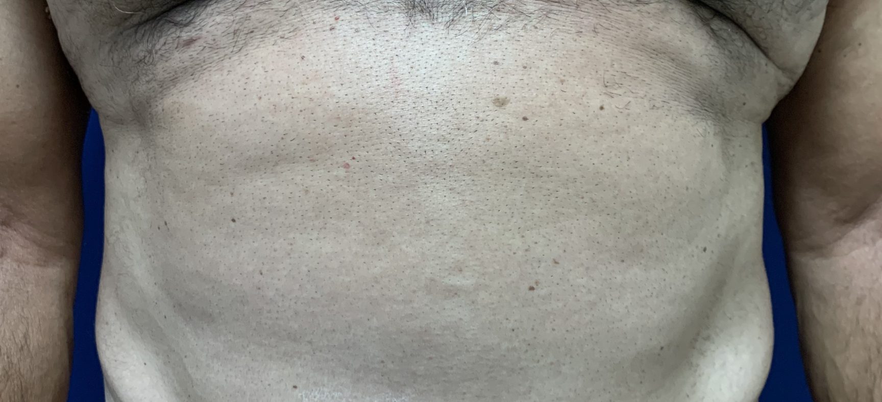 Tummy tuck-Abdominoplasty