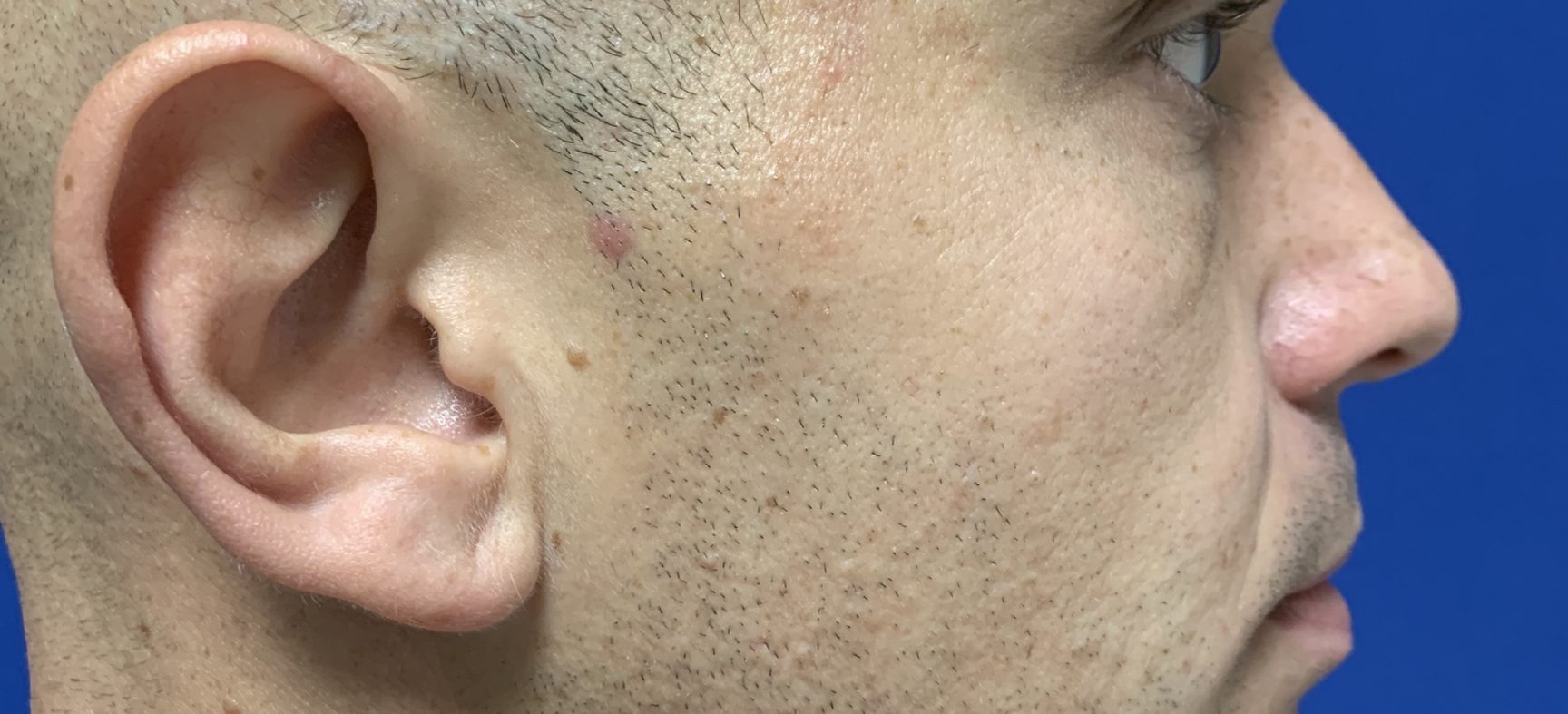 Facial Chin implant