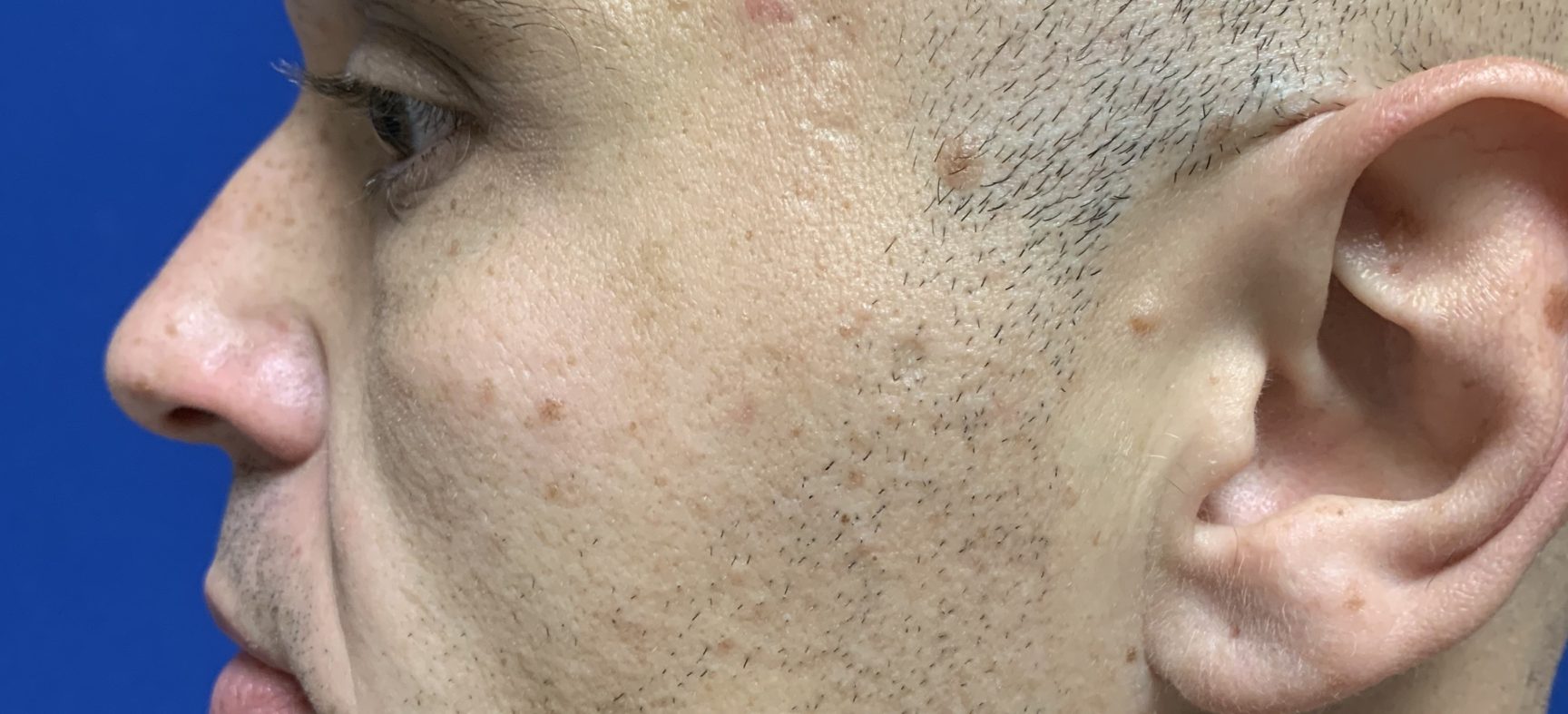 Neck lift