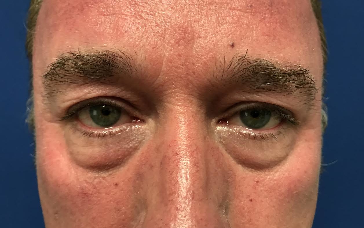 Eyelid surgery-blepharoplasty