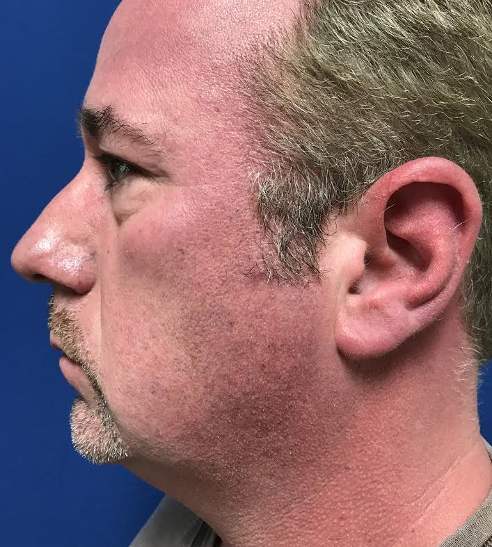 Neck lift