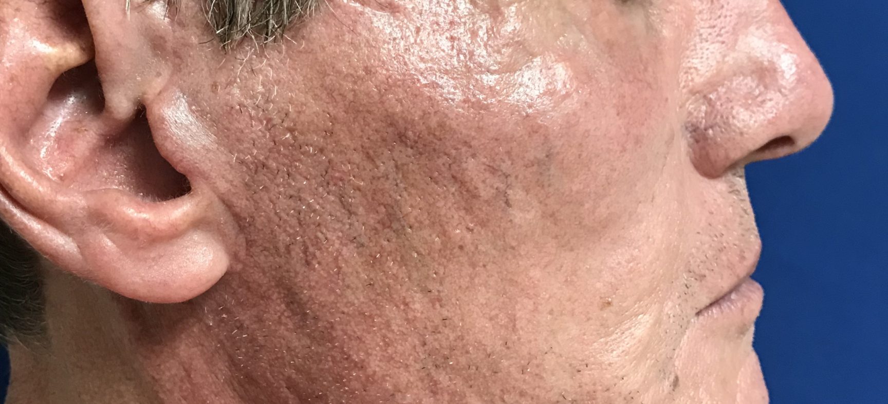 FACE AND NECK LIFT