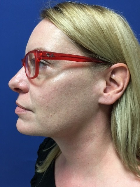 Neck Lift