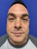 Jaw angle augmentation with implants