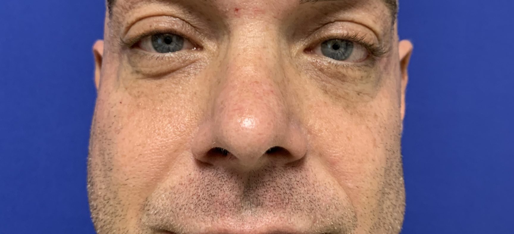 Jaw angle augmentation with implants