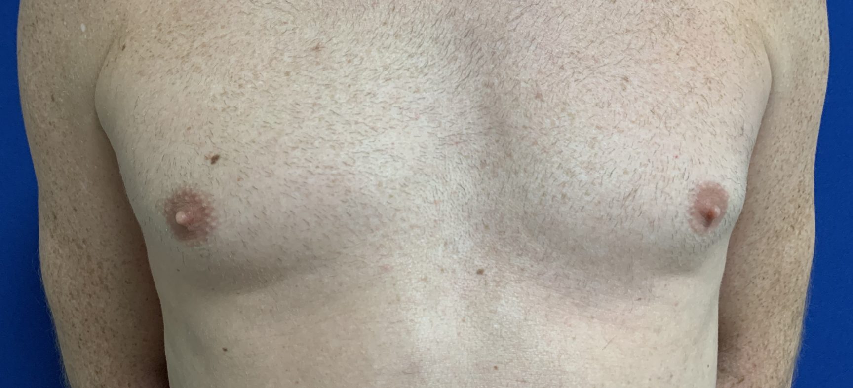 Breast fat grafts