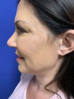 Neck lift