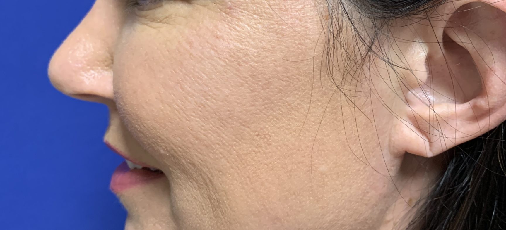 Neck lift