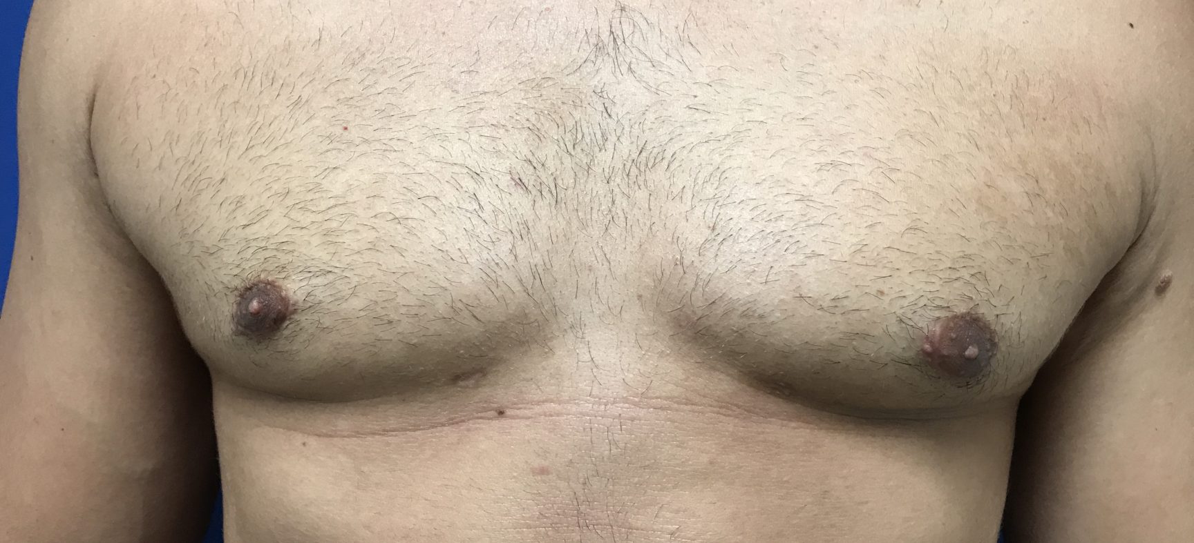 Male breast surgery- gynecomastia