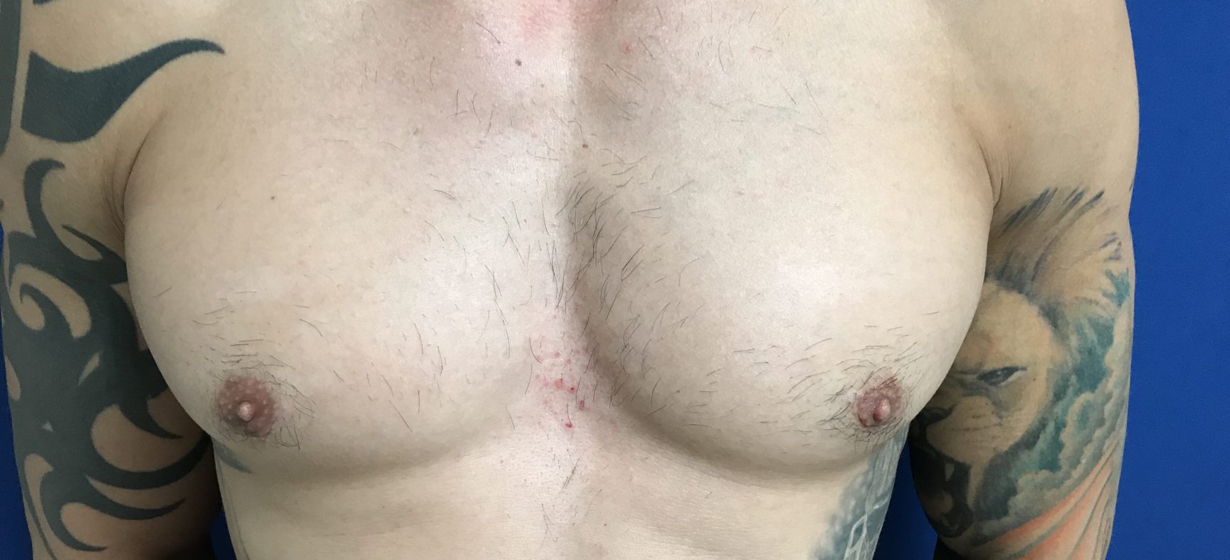 Male breast reduction surgery- gynecomastia