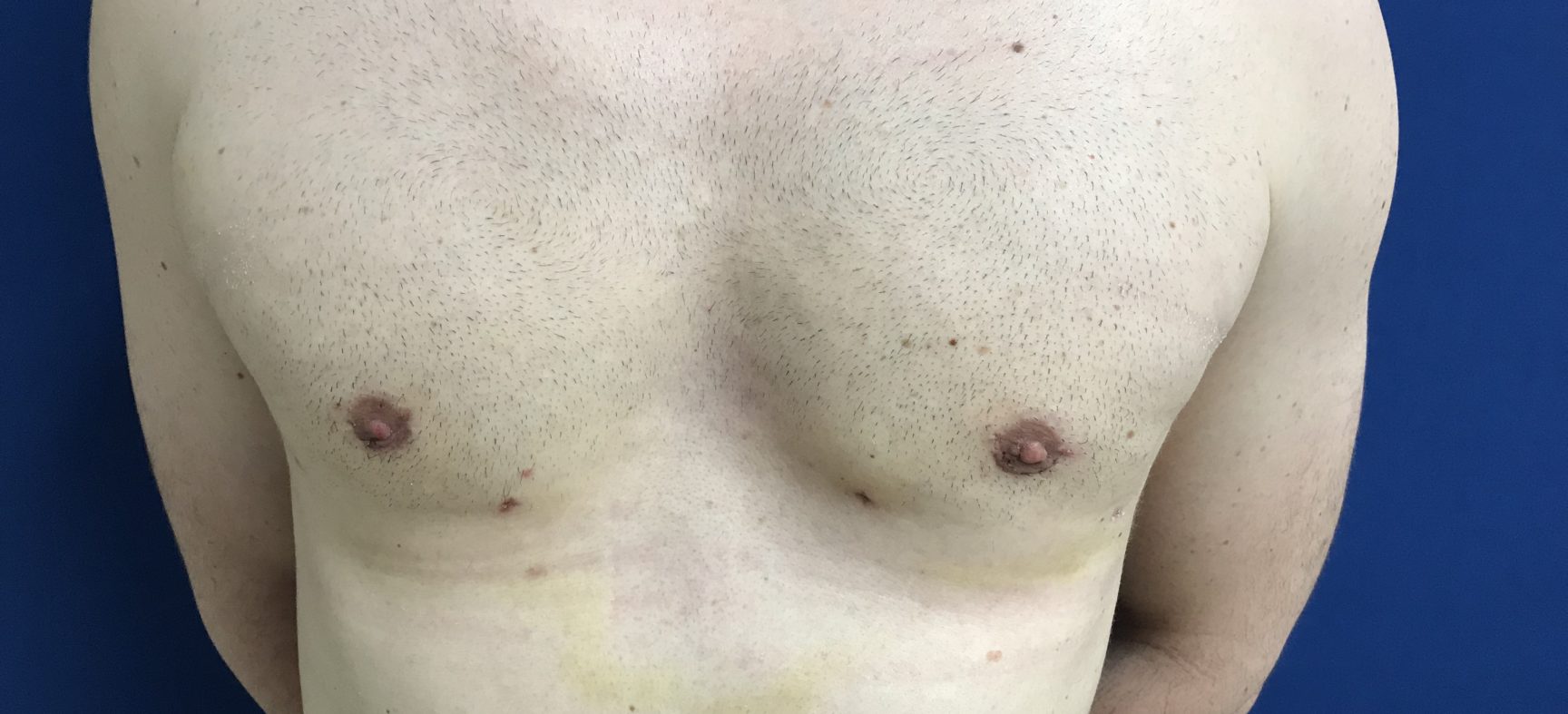 Male breast reduction- gynecomastia surgery