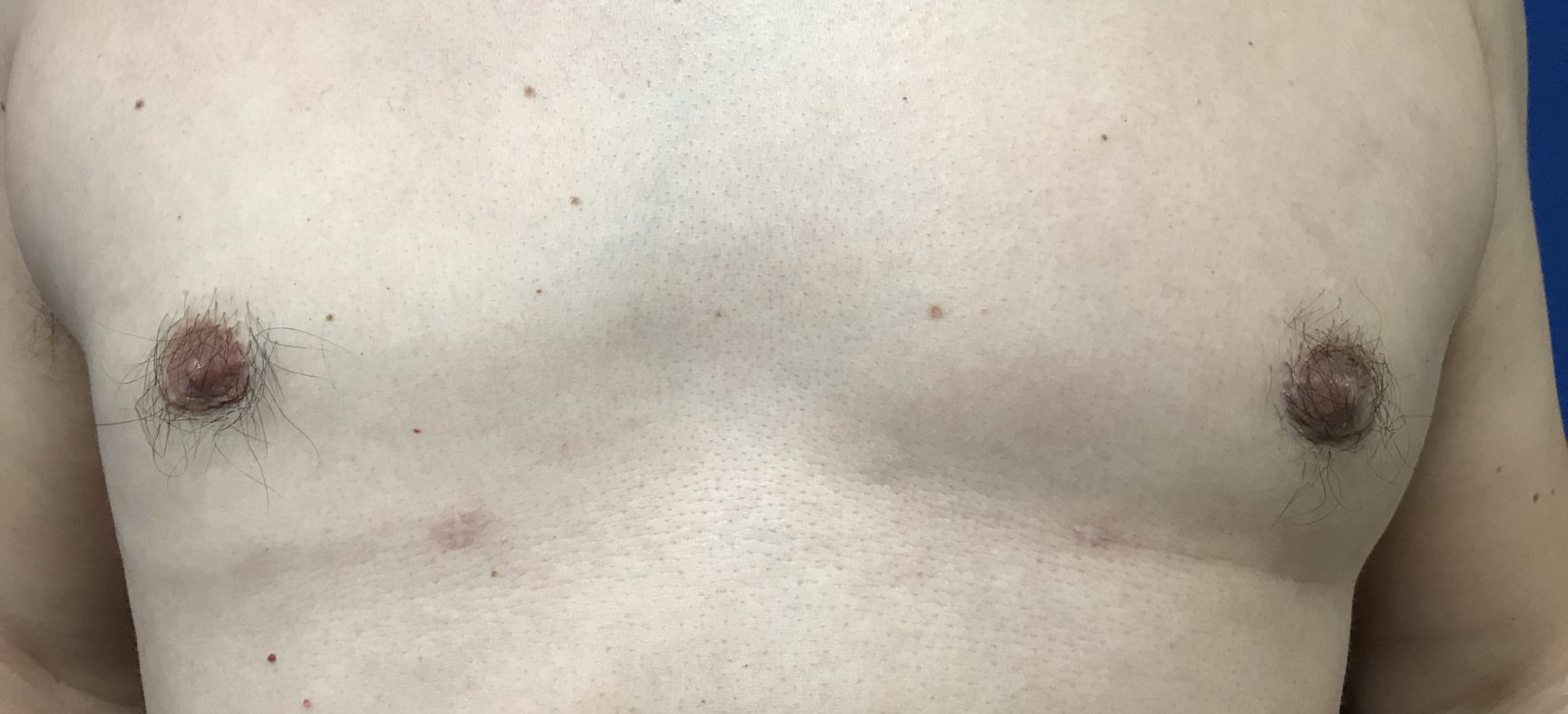 Male breast surgery- gynecomastia