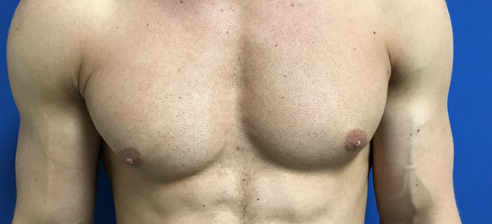 Male breast reduction surgery for gynecomastia