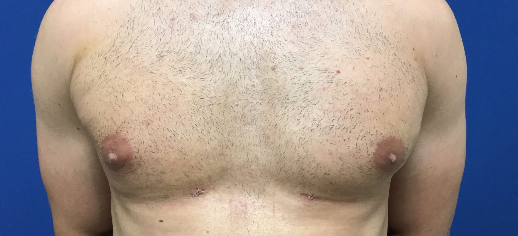 Male breast surgery for gynecomastia