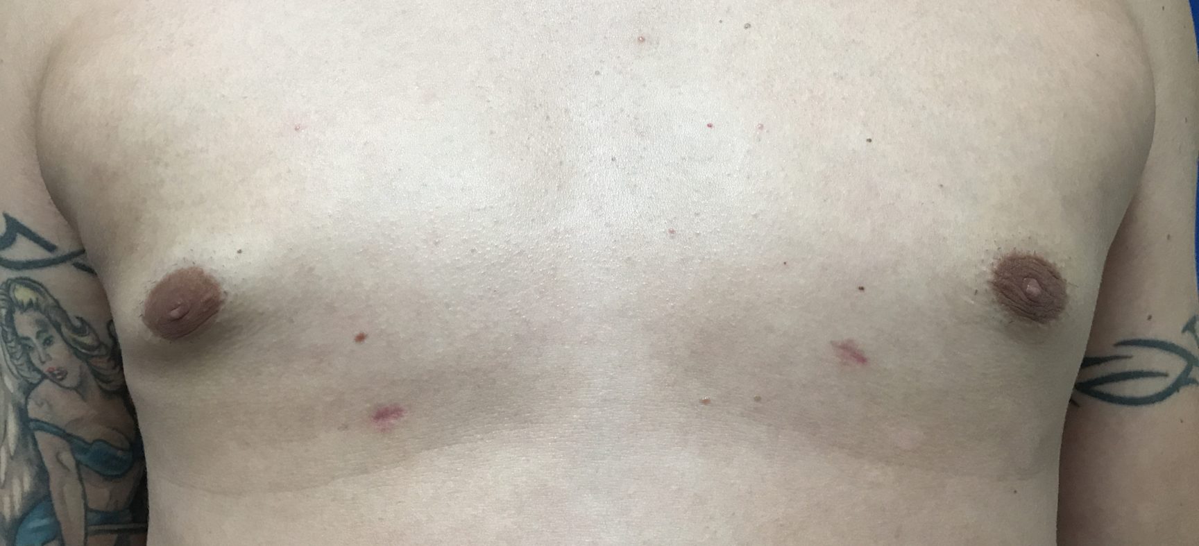 Male breast surgery- gynecomastia