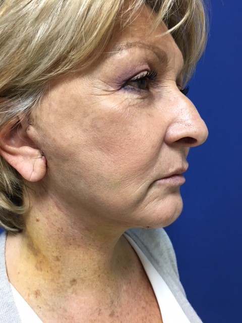 Face and Neck Lift- Secondary