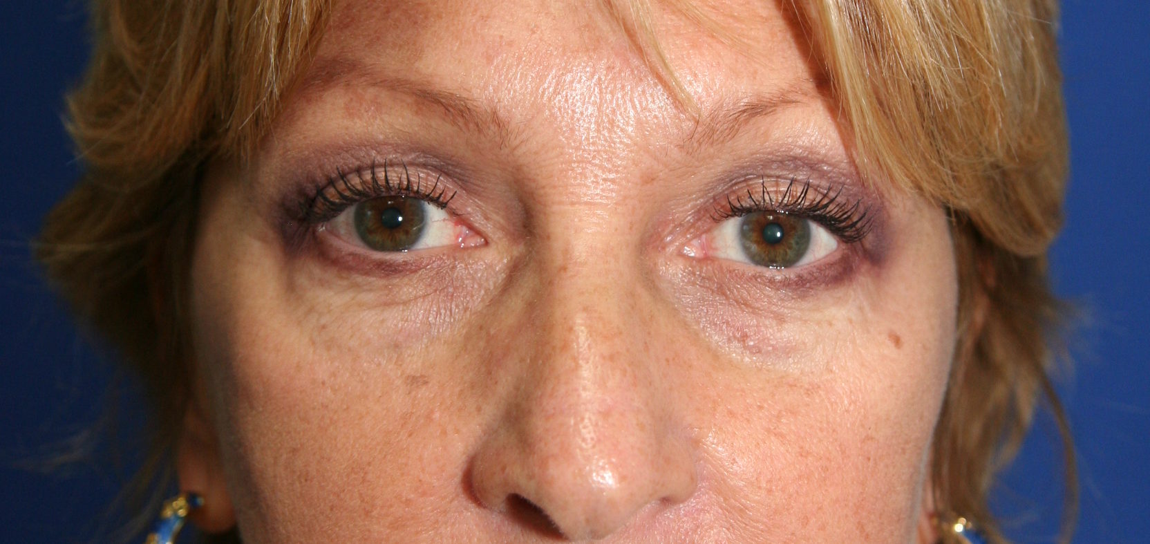Eyelid surgery- Blepharoplasty