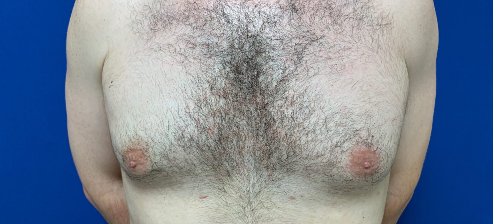 Male breast reduction for gynecomastia