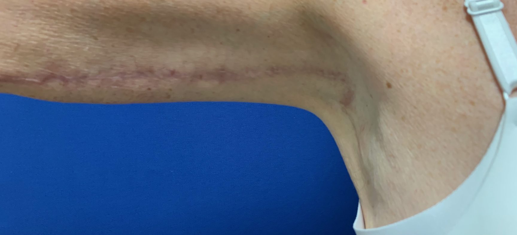 Arm lift- brachioplasty