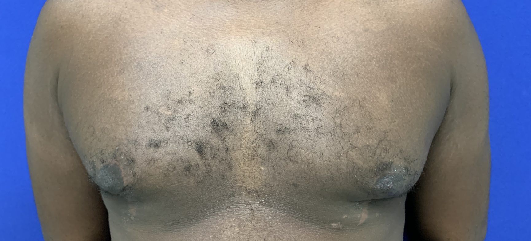 Male breast reduction for gynecomastia