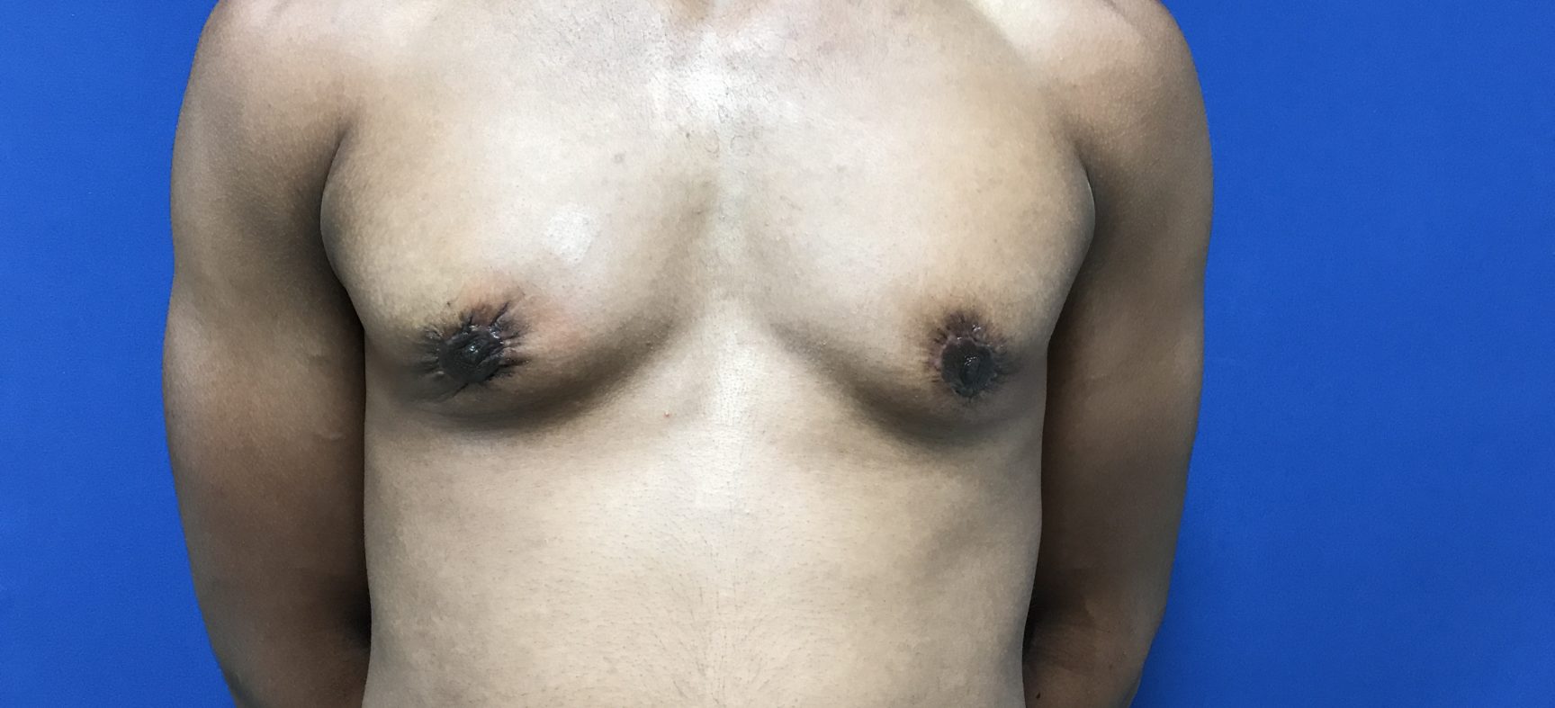 Male breast reduction for gynecomastia