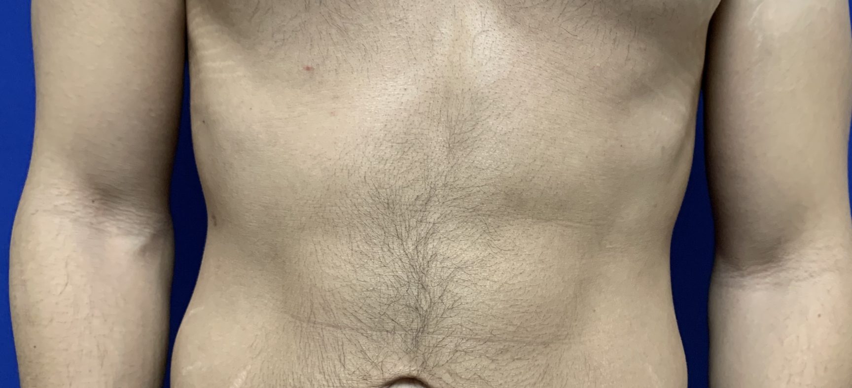 Liposuction