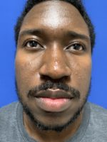 Facial Jaw Implants