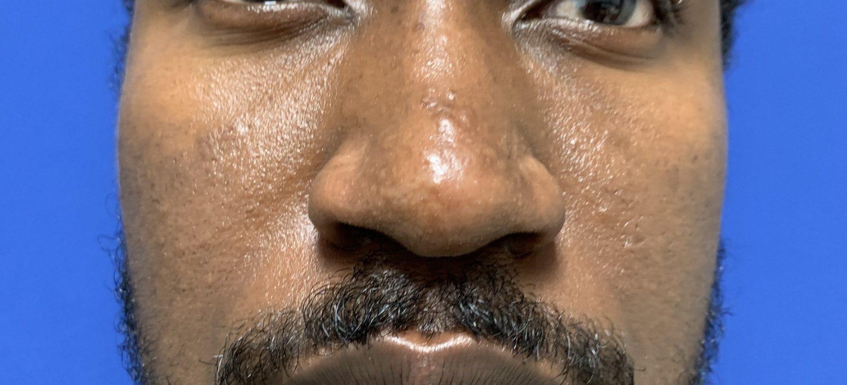 Facial Jaw Implants