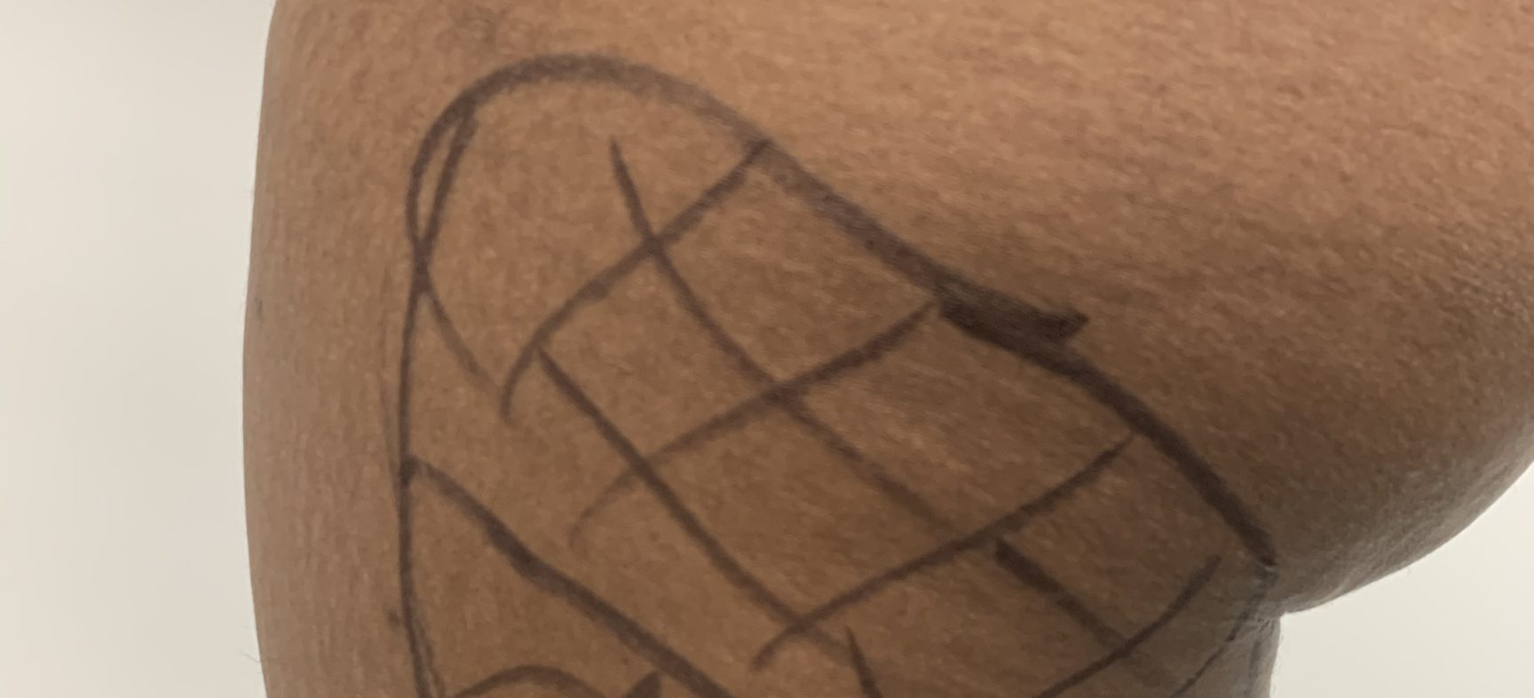Brazilian Butt Lift, Revision