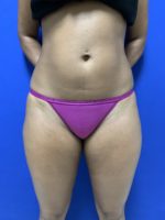 Liposuction of torso and thighs