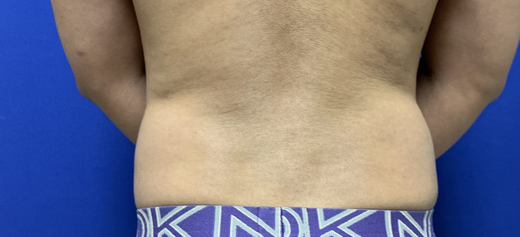 Liposuction, Contouring of Torso