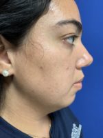 Chin augmentation with implant and neck liposuction